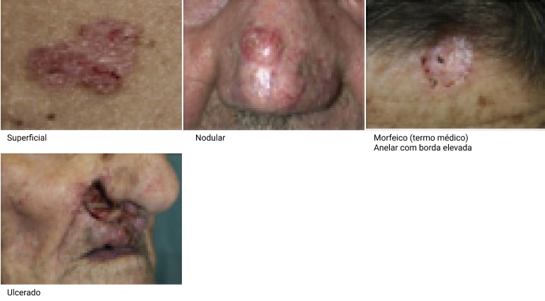 carcinoma-basocelular-min.jpg